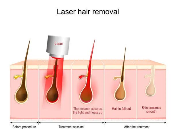 Laser hair removal: pigment in the follicle absorbs the light and heats, the hair sheds, and the follicle is disabled.